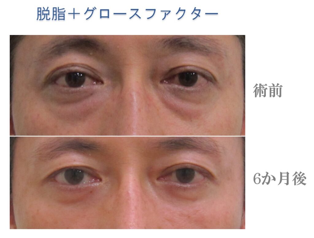 脱脂＋グロースファクター治療前後比較写真、経結膜脱脂法治療前後