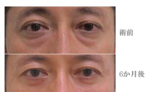 脱脂＋グロースファクター治療前後比較写真、経結膜脱脂法治療前後