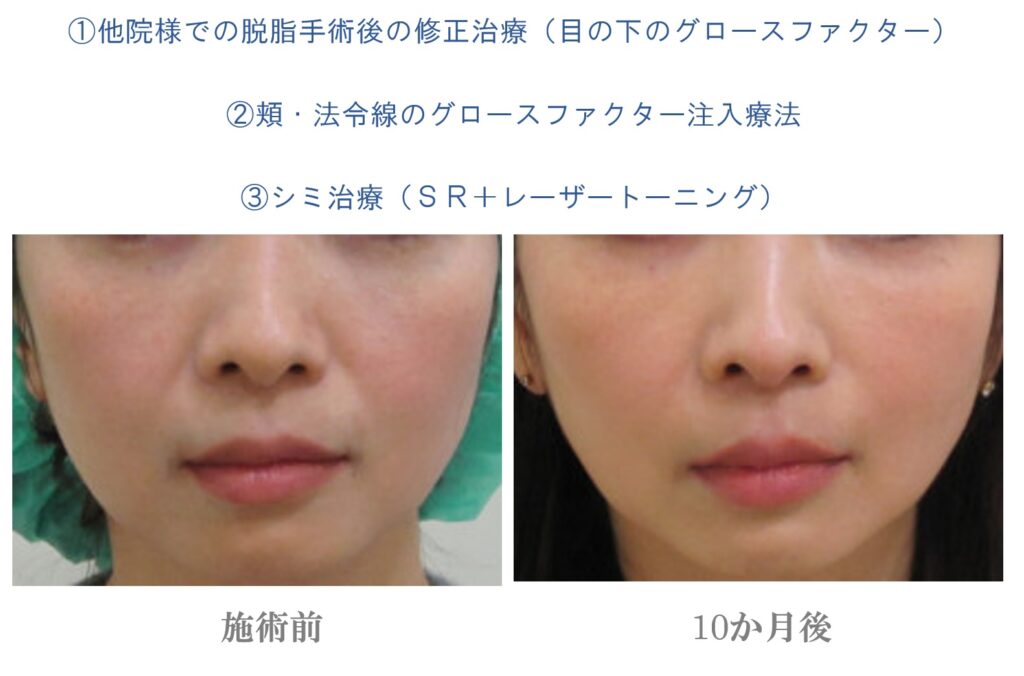 他院様での脱脂後の修正治療（目の下のグロースファクター）+頬・法令線のグロースファクター注入療法