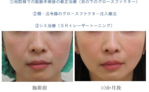 他院様での脱脂後の修正治療（目の下のグロースファクター）+頬・法令線のグロースファクター注入療法