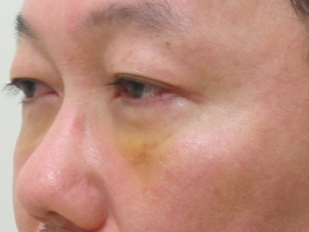 目の下の内出血の例　脱脂後1週間