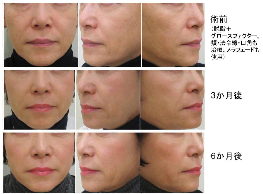 治療前後比較写真ー目の下のクマ治療（脱脂）