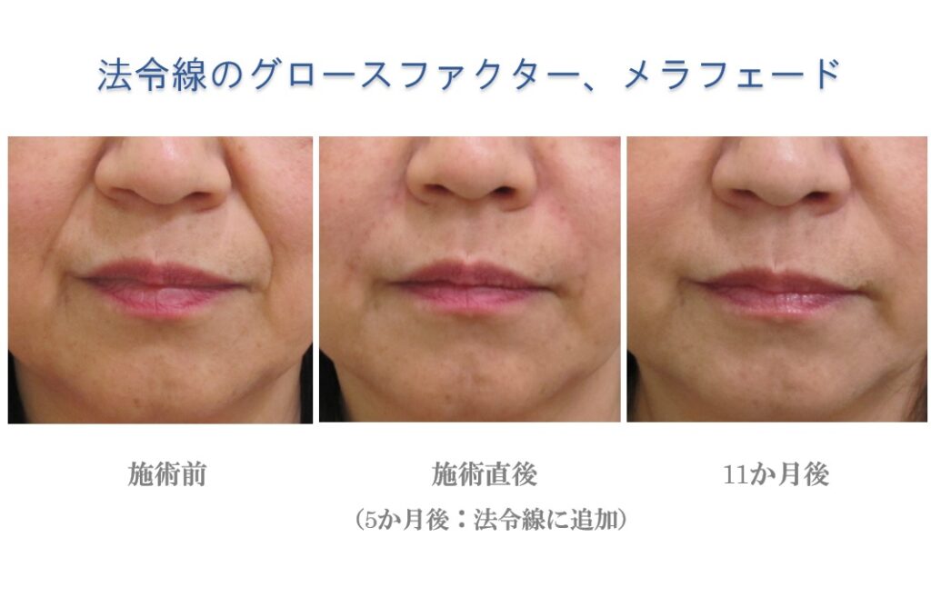 ほうれい線治療前後比較