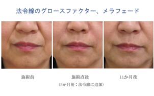 ほうれい線治療前後比較