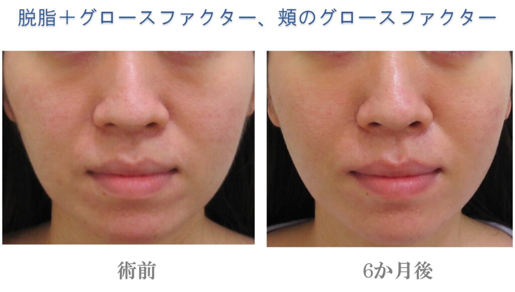 目の下のたるみ取り手術