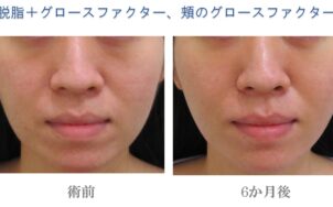 目の下のたるみ取り手術