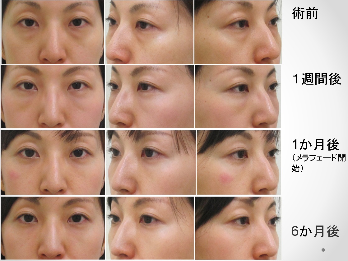 クマ 目の下 とり の 目の下のクマ・たるみ取りのよくある失敗とその回避法│美容外科の医師監修コラム