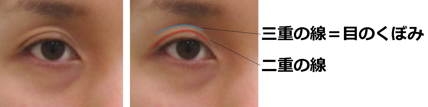 三重まぶた