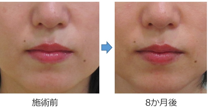 50代の方の鼻横のくぼみ改善例