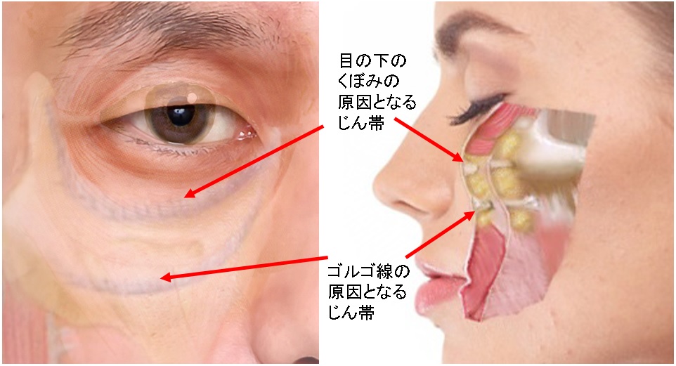 頬のたるみ ゴルゴ線 形成外科専門医が解説