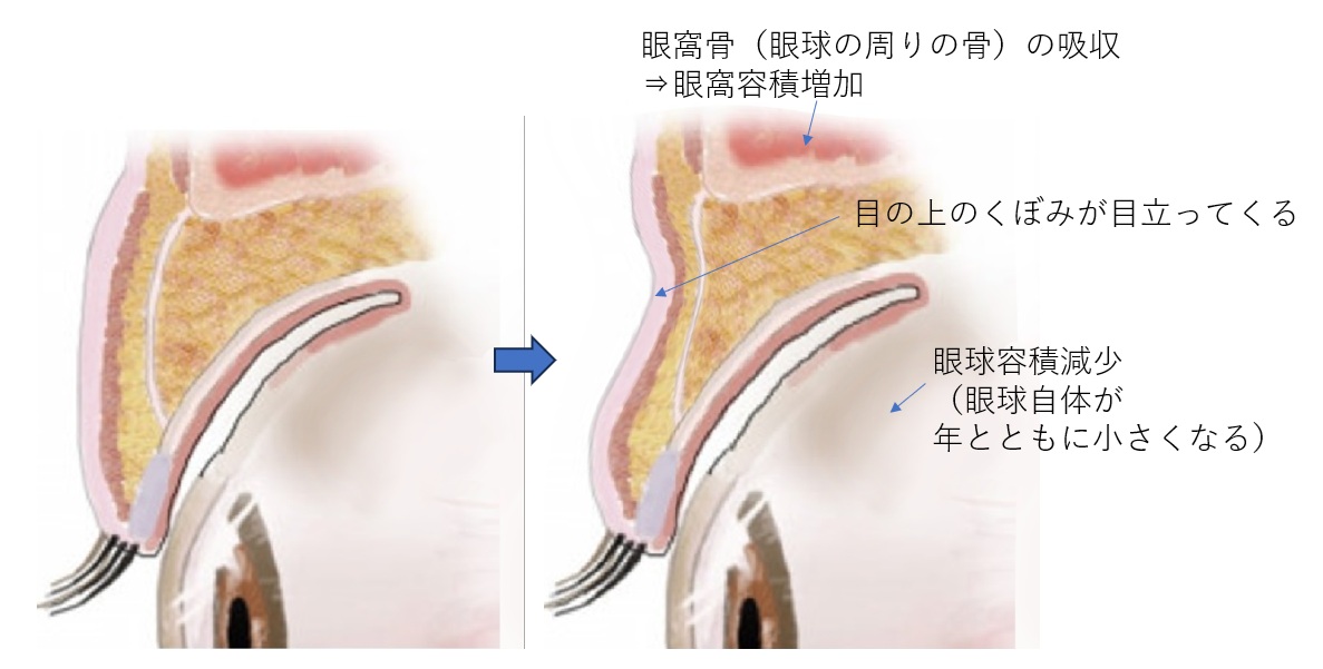 目の上のくぼみの原因