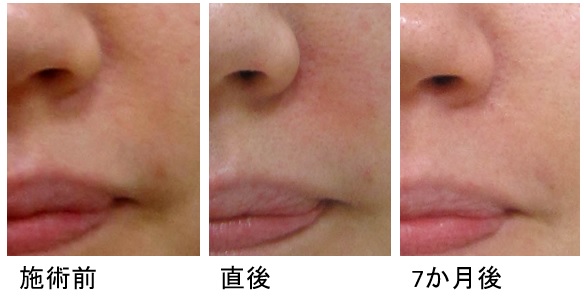 鼻横のくぼみ改善例