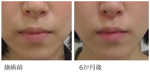 鼻横の溝治療の改善例