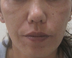 顔全体のグロースファクター（目の下・頬・ほうれい線・口角）症例写真