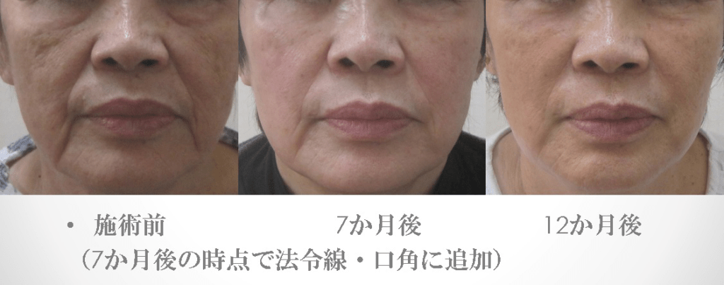 顔全体のグロースファクターによるシワたるみ治療1年の経過