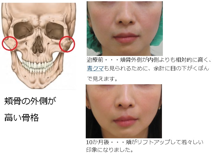 目の下のたるみクマ治療　頬骨外側が高い方の骨格に基づいた頬のリフトアップ