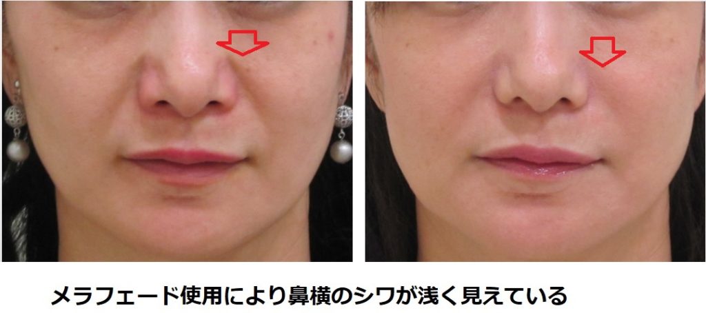 メラフェードによる鼻横のシワ改善