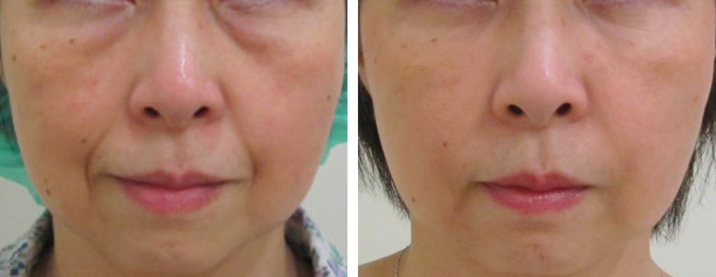 脱脂、目の下・頬・法令線のグロースファクター治療前後比較