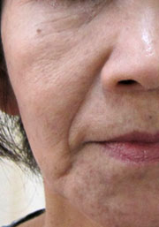 顔全体（目の下・頬・ほうれい線・口角）のグロースファクター施術前