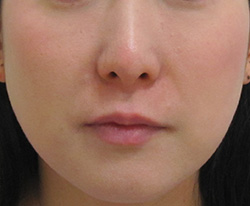 顔全体のグロースファクター（目の下・頬・ほうれい線・口角）症例写真