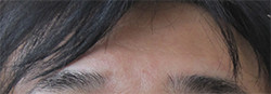 額のグロースファクター症例写真