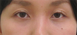 目の上のくぼみのグロースファクター症例写真