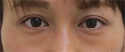 目の下のクマ・くぼみ・シワの施術前写真