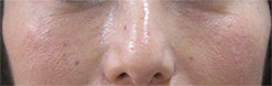 目の下のクマ・くぼみ・シワのグロースファクター症例写真