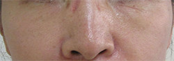 目の下のクマ・くぼみ・シワのグロースファクター症例写真