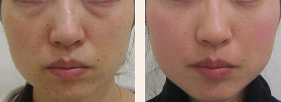 顔のたるみ治療の症例写真