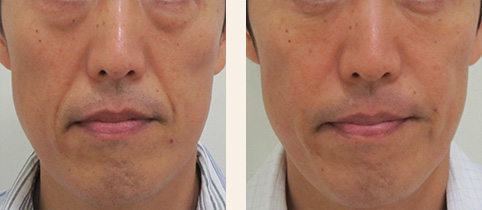 顔のたるみ治療の症例写真
