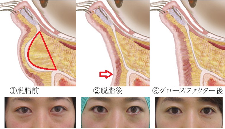 目の下のくぼみにはふくらみ（目の下の脂肪）が混ざっていることが多いですが、脱脂手術＋グロースファクターで改善します。