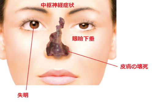 ヒアルロン酸 失敗 鼻 ヒアルロン酸による皮膚壊死の副作用・リスクについて