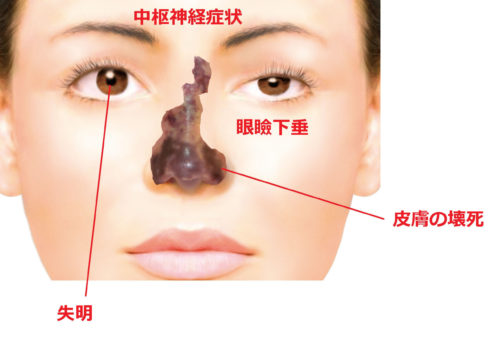 ヒアルロン酸 失敗 鼻