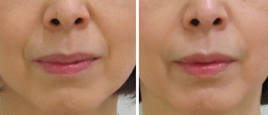 頬の厚みが少ない方のほうれい線治療例で上の方が片側シワが残っている例