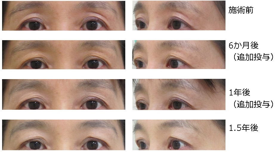目のくぼみ治療経過(重度の例）