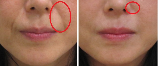 頬の厚みが少ない方のほうれい線治療例（頬の脂肪の厚みの左右差）