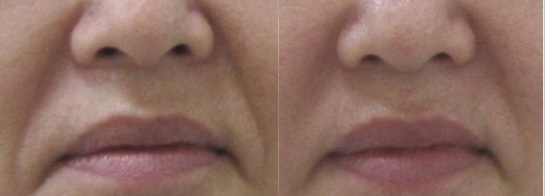 頬の脂肪の厚みがかなりある方のほうれい線治療例