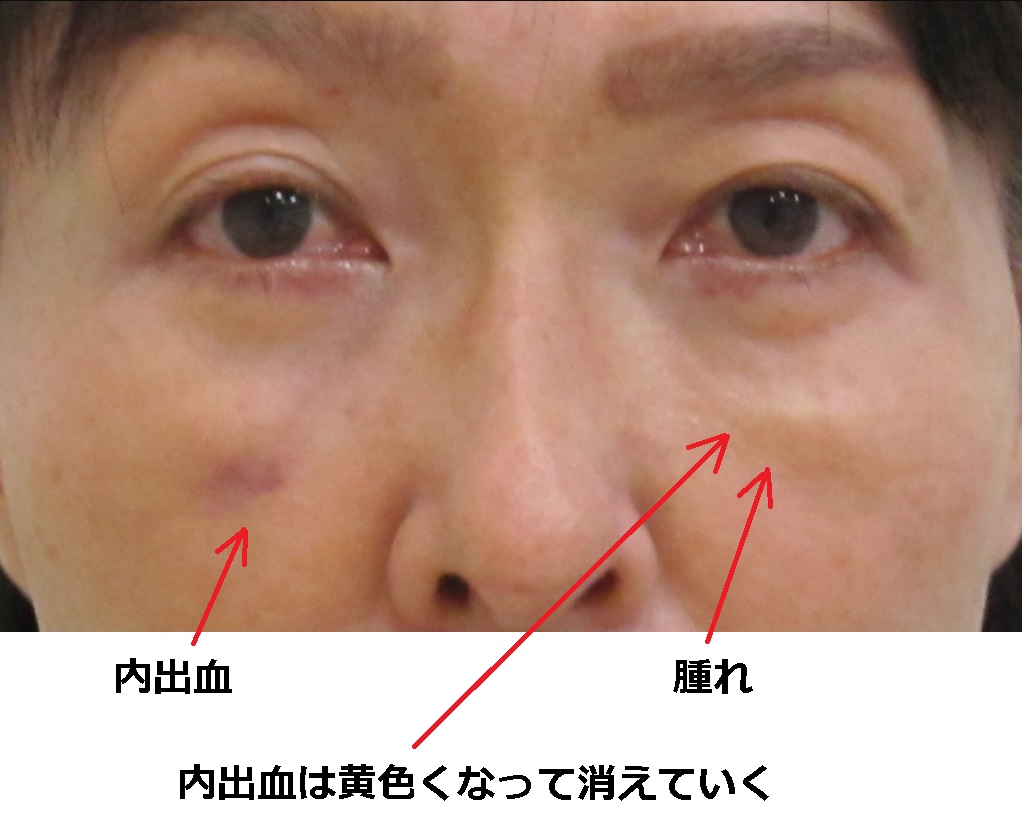 内出血と腫れ　目の下の脱脂後