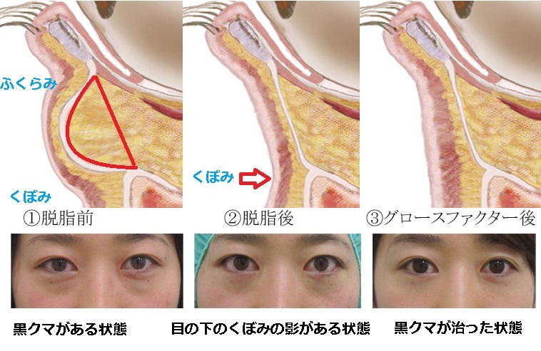 黒クマ 特徴と原因 見分け方 ご自分でできる対策と治し方