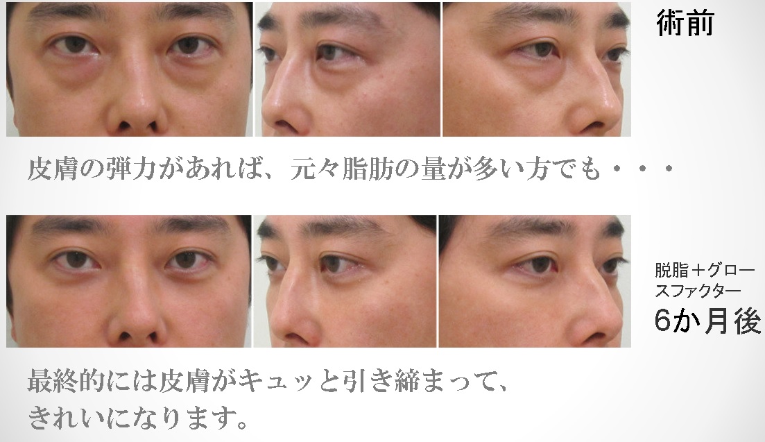 脱脂後の目の下のシワ 事前に予測する方法と予防法 解消法
