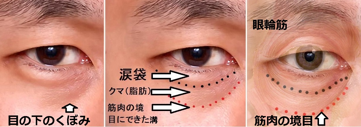 目の下のくぼみができる３つの原因