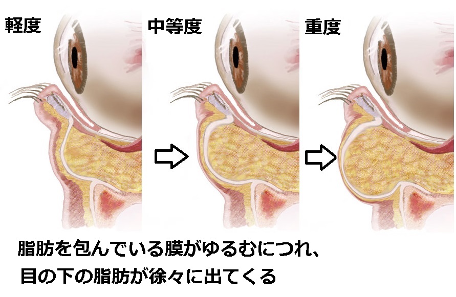 目の下の脂肪の進行　重症度