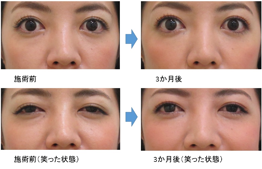 検証 笑った時の目の下のたるみ ふくらみが手術なしでも改善