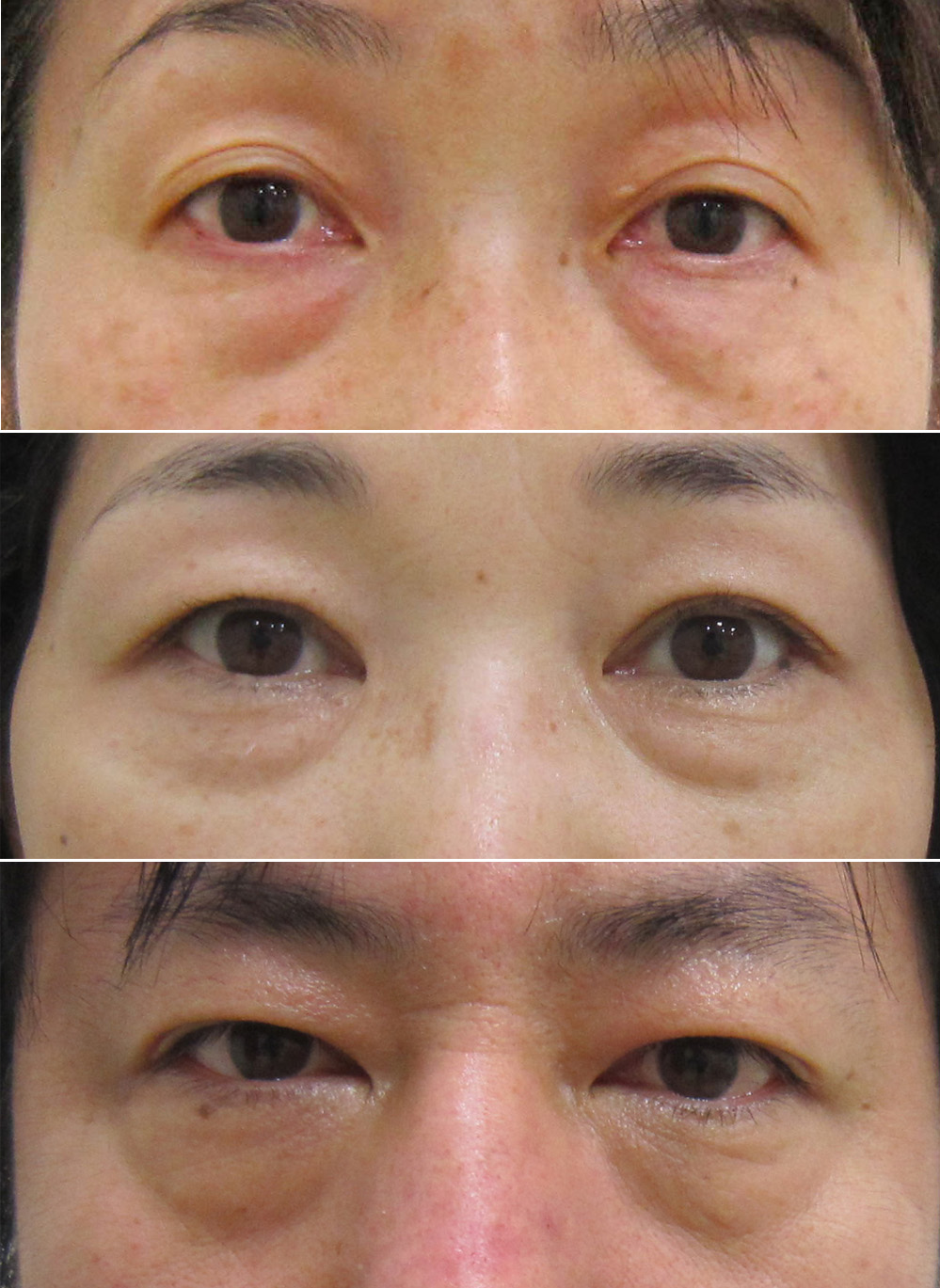 目の下のヒアルロン酸注入 目の下のくぼみ クマ治療の注意点