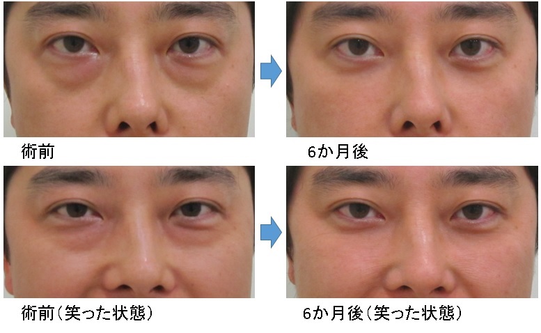 検証 笑った時の目の下のたるみ ふくらみが手術なしでも改善