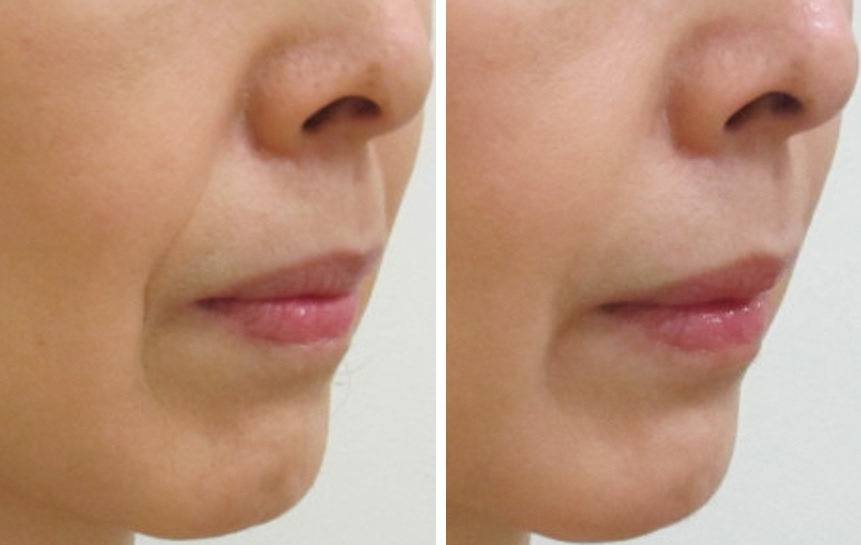 頬の脂肪の厚みの影が軽度ある方のほうれい線治療例の横向き