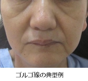 頬のたるみ ゴルゴ線 形成外科専門医が解説