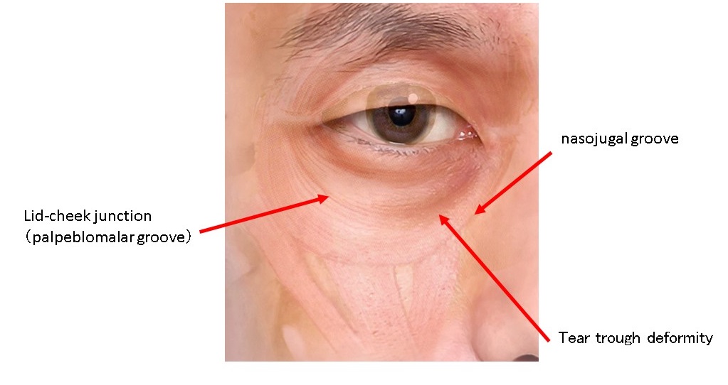 目の下のくぼみ ふくらみ 涙袋の名前 画像で徹底解説