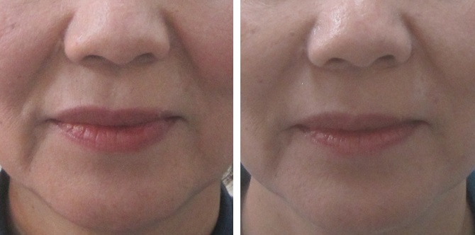 頬の脂肪の厚みの影が多い方のほうれい線治療例